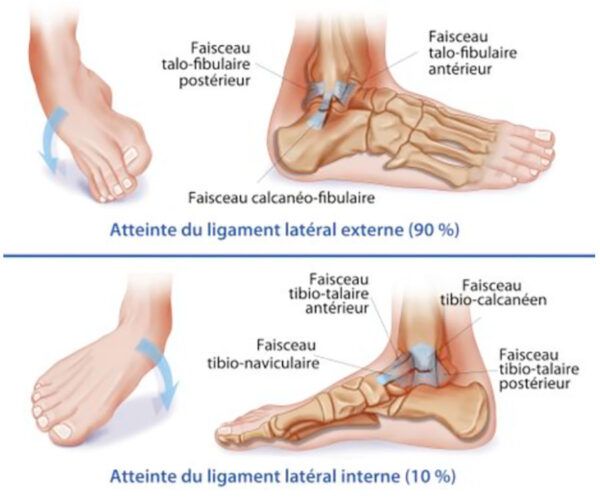 Parcourez notre article sur l'entorse de la cheville et les symptômes chez Kinatex Sports Physio, Québec et Ontario.