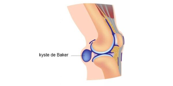 Parcourez notre article sur le kyste de Baker et de la douleur au genou chez Kinatex Sports Physio, Québec et Ontario.