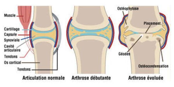 L'arthrose de la main sur les causes avec Kinatex Sports Physio, Québec et Ontario