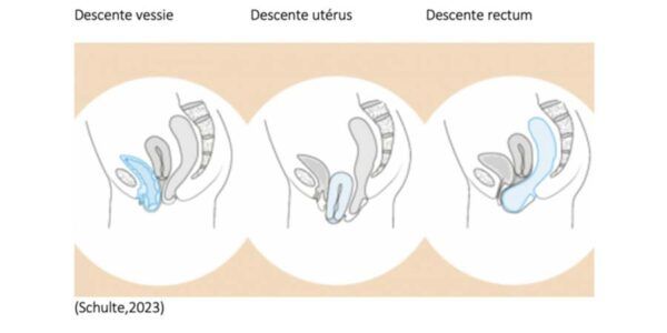 Démystifier les pessaires par la descente de paroie chez Kinatex Sports Physio, Québec et Ontario