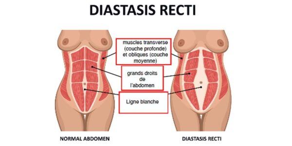 La grossesse, démystifions la diastase et les grands droits avec Kinatex Sports Physio, Québec et Ontario