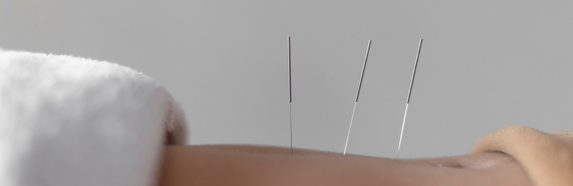 L’acupuncture et la gestion de l’anxiété avec Kinatex Sports Physio, Québec et Ontario